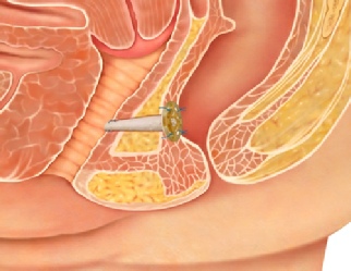 Perianal Abscess Fistula in Ano Causes Treatment Surgery